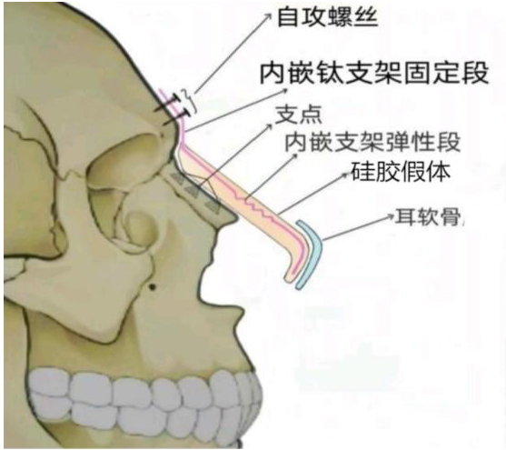 用于鼻尖整形的弹性支架及假体