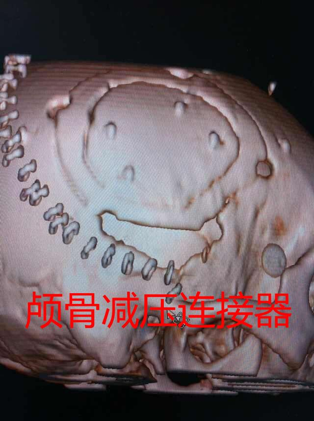 颅骨减压连接器及系列神经外科新产品